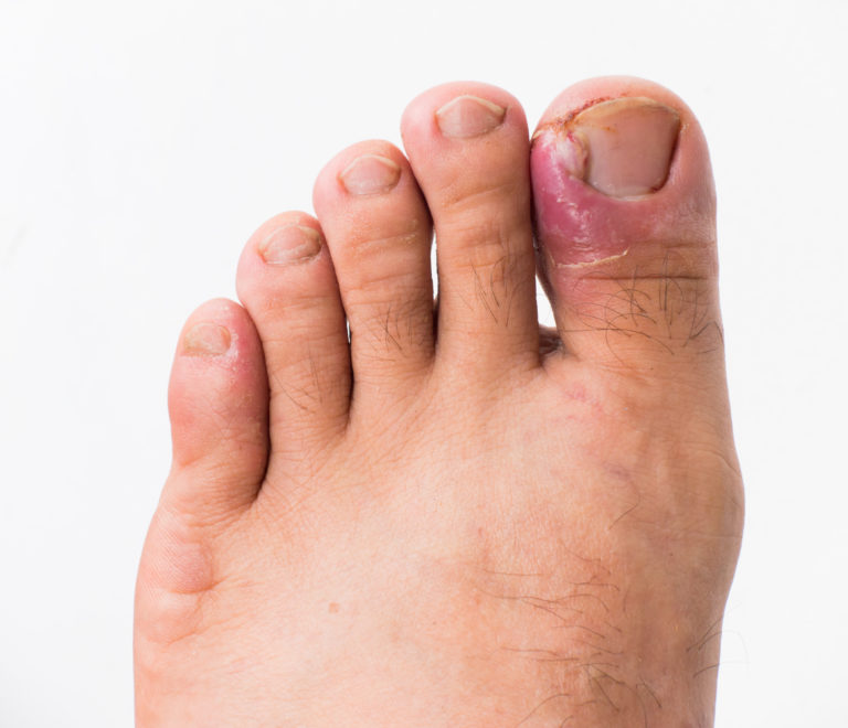 Nail Surgery (Double nail) No Discount