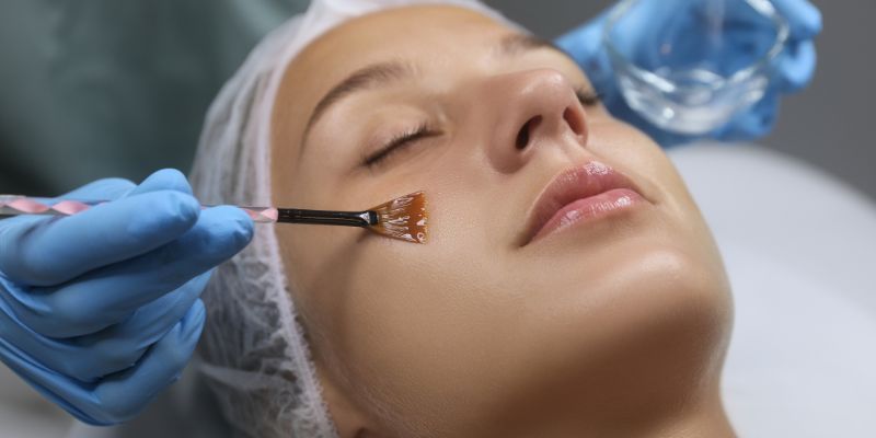 Chemical Peeling (Per Session)