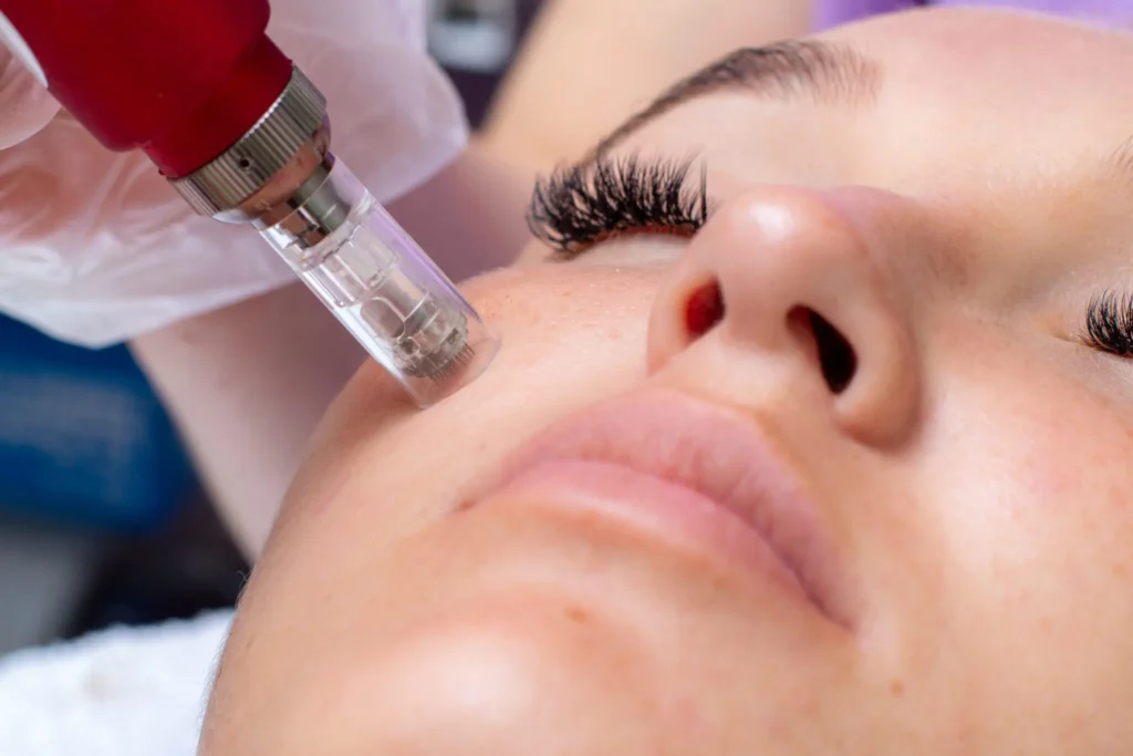 Microneedling (Per Session)