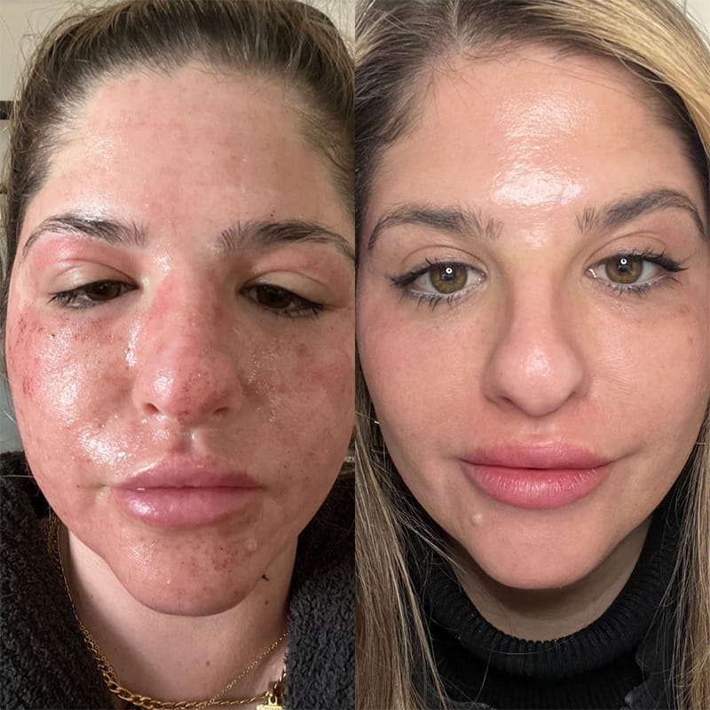 CO2 Laser (Per Session)